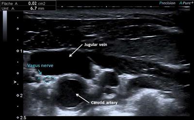 Ultrasonography of the Vagus Nerve in Parkinson's Disease